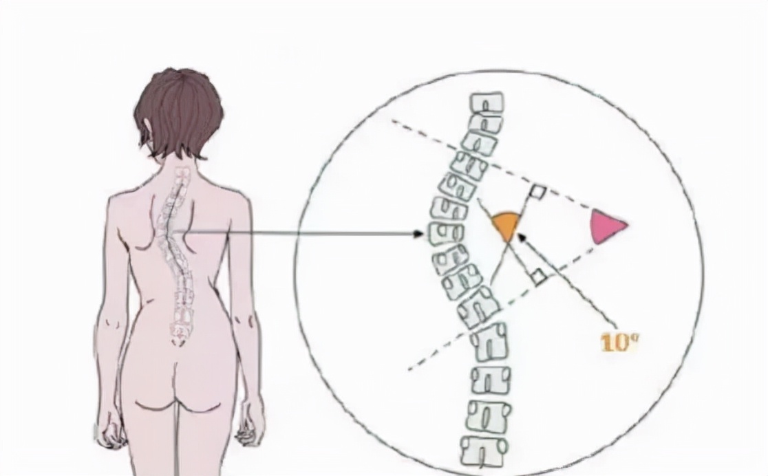 您所关心的正是我们关注的---儿童青少年脊柱侧弯(图5)