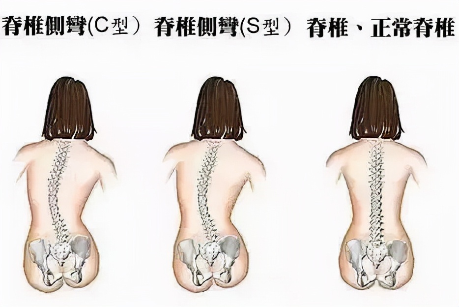 孩子脊椎变形的原因您知道多少？(图1)